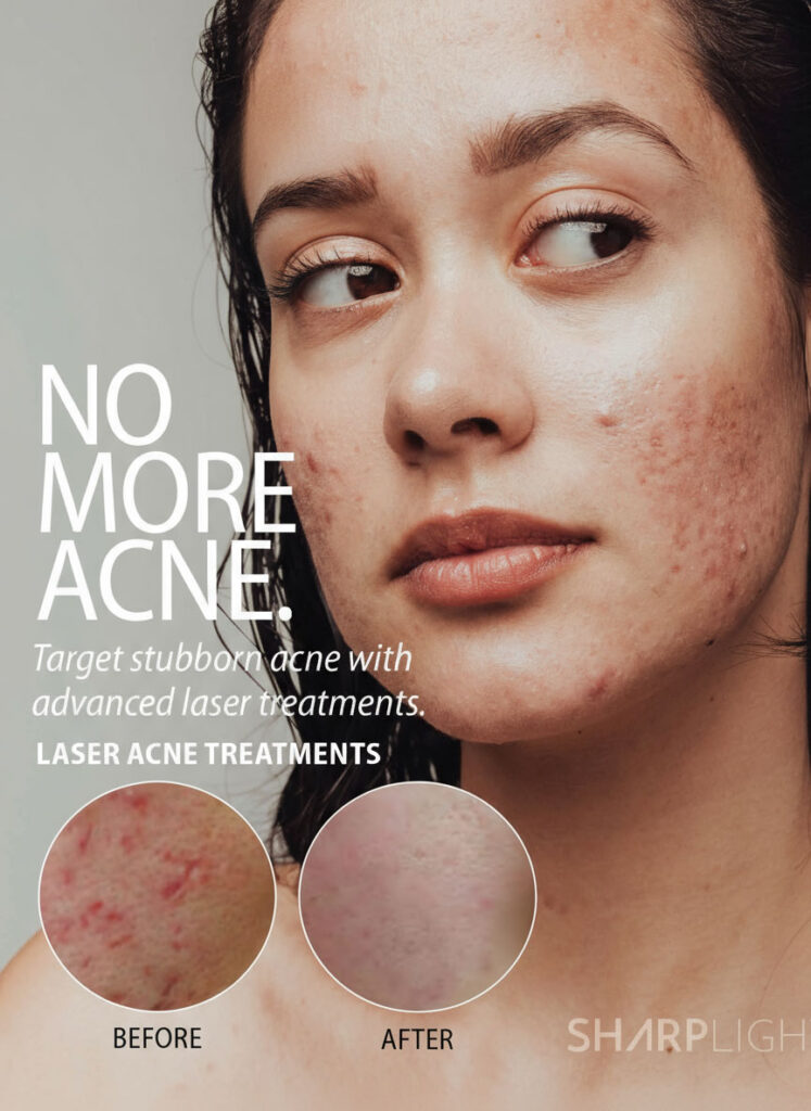 Eye Candy Beauty Studio - Acne Treatments